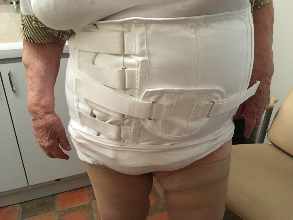 ceintures abdominale sur mesure fait près de Tours , Chinon , Azay le rideau par un orthopédiste-orthésiste.
