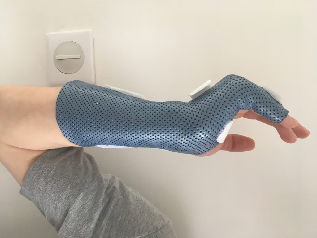 orthèse de main thermoformée pour fracture du 5ème Métacarpe urgences tours .
