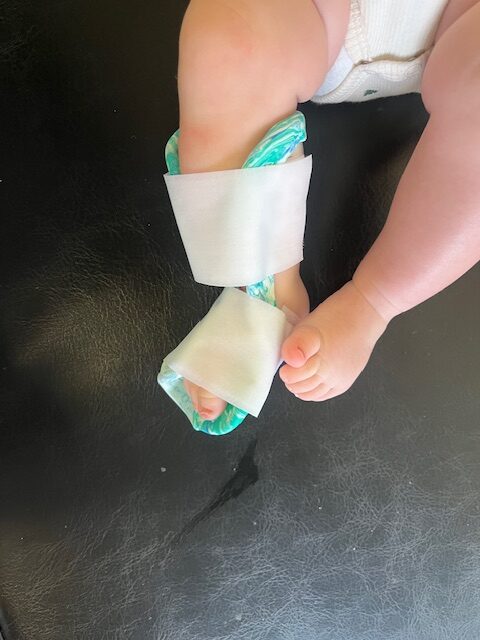 Attelle thermoformée pour un pied talus valgus sur un bébé de 4 mois